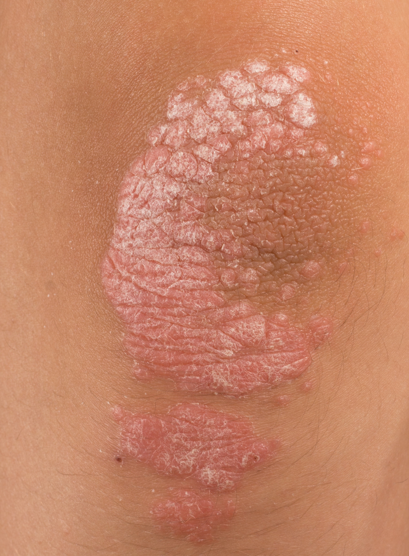 Psoriasis on the knee